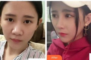 皖北煤電集團總醫(yī)院醫(yī)學美容中心朱曉云整形價格表附鼻部綜合案例展示