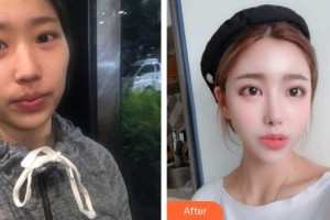 普寧伊麗莎白醫(yī)療美容診所孫杰整形價格表附切開雙眼皮案例展示