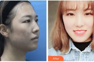 普寧伊麗莎白醫(yī)療美容診所李鐵軍整形價格表附眼部手術(shù)案例展示