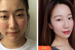 普寧市人民醫(yī)院眼科方曉珊整形價格表附切開雙眼皮案例展示