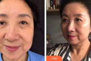 普寧市人民醫(yī)院眼科黃伯健整形價格表附內(nèi)切祛眼袋案例展示