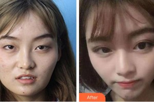 普寧市人民醫(yī)院眼科余杰克整形價格表附眼部綜合案例展示