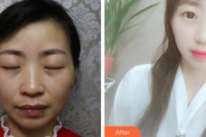 普寧市人民醫(yī)院眼科蔡偉彬整形價格表附眼部綜合案例展示