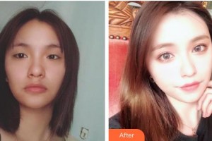 普寧市人民醫(yī)院眼科李煥生整形價格表附切開雙眼皮案例展示