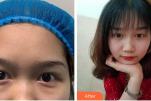 廣空后勤醫(yī)院整形美容中心張靜整形價格表附切開雙眼皮案例展示