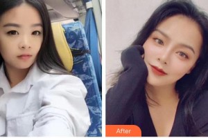 廣空后勤醫(yī)院整形美容中心劉峰整形價格表附眼部綜合案例展示