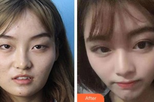 廣空后勤醫(yī)院整形美容中心冼紀雯整形價格表附眼部綜合案例展示