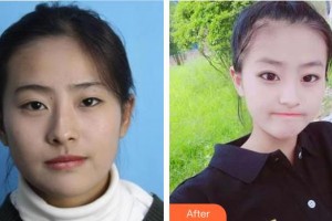 廣空后勤醫(yī)院整形美容中心肖美玲整形價格表附眼部綜合案例展示