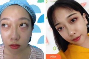 連云港徐楊醫(yī)療美容門診部王莉燕整形價(jià)格表附內(nèi)切祛眼袋案例展示