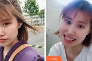 西昌玥美整形美容醫(yī)院湯穎峰整形價格表附金屬托槽矯正案例展示