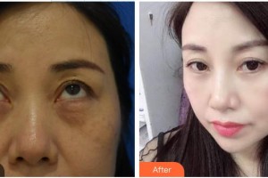 南昌大學(xué)附屬眼科醫(yī)院易敬林整形價格表附激光去眼袋案例展示