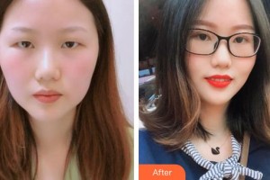 南昌大學(xué)附屬眼科醫(yī)院張旭整形價格表附切開雙眼皮案例展示