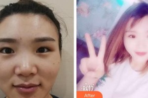 南昌大學(xué)附屬眼科醫(yī)院程玲整形價格表附切開雙眼皮案例展示