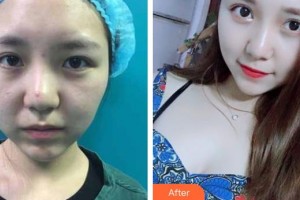 南昌大學(xué)附屬眼科醫(yī)院楊璐整形價格表附切開雙眼皮案例展示