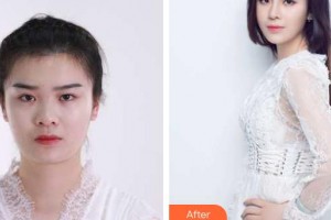 南昌大學(xué)附屬眼科醫(yī)院徐柒華整形價格表附埋線雙眼皮案例展示