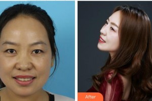 南昌大學(xué)附屬眼科醫(yī)院艾麗珍整形價格表附眼部修復(fù)案例展示