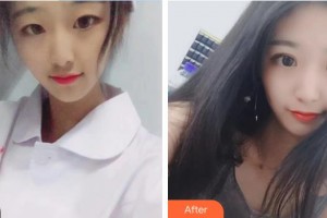 南昌大學(xué)附屬眼科醫(yī)院魯宇容整形價格表附眼部綜合案例展示