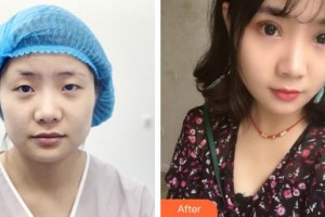 南昌大學(xué)附屬眼科醫(yī)院黃傳華整形價格表附眼部綜合案例展示