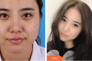 南昌大學(xué)附屬眼科醫(yī)院黃琴整形價格表附眼部修復(fù)案例展示