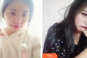 南昌大學(xué)附屬眼科醫(yī)院余學(xué)清整形價格表附眼部綜合案例展示