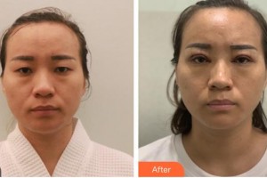 南昌大學(xué)附屬眼科醫(yī)院古學(xué)軍整形價格表附眼部綜合案例展示