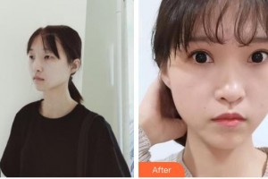 南昌大學(xué)附屬眼科醫(yī)院甘莆英整形價格表附眼部綜合案例展示