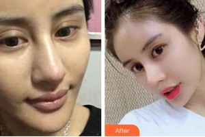 南昌大學(xué)附屬眼科醫(yī)院劉賢整形價格表附眼部綜合案例展示