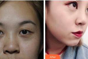 南昌愛爾眼科醫(yī)院朱加貴整形價格表附定點雙眼皮案例展示