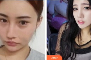 東南大學(xué)附屬中大醫(yī)院整形外科寧官森整形價(jià)格表附鼻部綜合案例展示