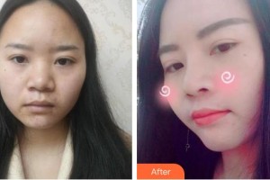 皖南醫(yī)學(xué)院弋磯山醫(yī)院整形外科朱唯力整形價(jià)格表附鼻部綜合案例展示