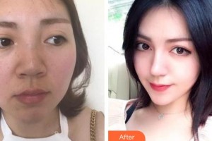 雞西王醫(yī)生整形外科門診部徐瑞宏整形價(jià)格表附硅膠隆鼻案例展示