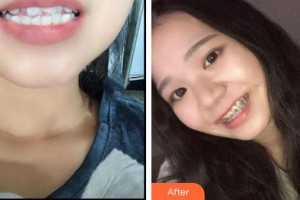 雞西王醫(yī)生整形外科門診部丁優(yōu)整形價格表附金屬托槽矯正案例展示