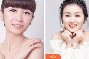 北醫(yī)整形美容外科門診部劉文華整形價格表附牙齒陶瓷矯正案例展示