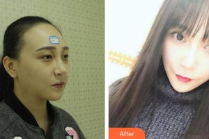 咸陽(yáng)華爾醫(yī)療美容門(mén)診部張秦鵬整形價(jià)格表附埋線(xiàn)雙眼皮案例展示