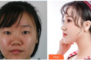 咸陽(yáng)華爾醫(yī)療美容門(mén)診部史娟娟整形價(jià)格表附眼部綜合案例展示