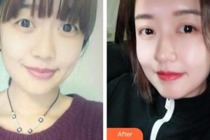 咸陽(yáng)華爾醫(yī)療美容門(mén)診部孫瑞陽(yáng)整形價(jià)格表附切開(kāi)雙眼皮案例展示