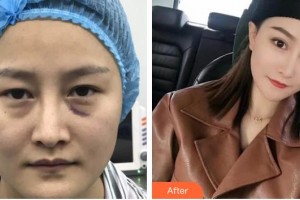 咸陽(yáng)愛(ài)爾眼科醫(yī)院周善文整形價(jià)格表附切開(kāi)雙眼皮案例展示