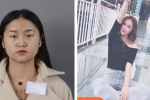 咸陽彩虹醫(yī)院整形美容科羅曼整形價格表附切開雙眼皮案例展示