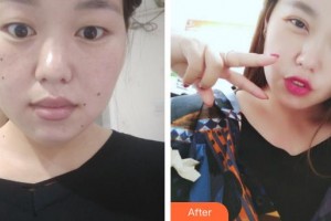 咸陽市第一人民醫(yī)院眼科醫(yī)院王升整形價格表附切開雙眼皮案例展示