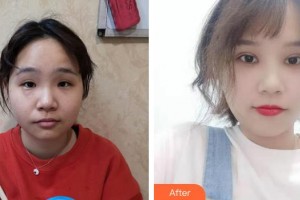 咸陽市第一人民醫(yī)院眼科醫(yī)院王敏整形價格表附眼部綜合案例展示