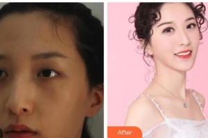 咸陽市第一人民醫(yī)院眼科醫(yī)院裴瑞整形價格表附切開雙眼皮案例展示