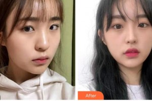 瑞安市人民醫(yī)院眼科陳鎮(zhèn)國整形價(jià)格表附定點(diǎn)雙眼皮例展示