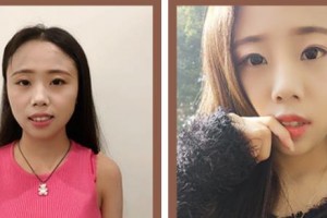 北海博鏵醫(yī)院整形美容中心趙耀忠整形價(jià)格表附金屬托槽矯正案例展示