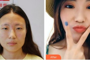 甘肅省康復(fù)中心醫(yī)院眼科中心王登廷整形價格表附切開雙眼皮案例展示