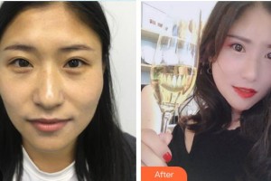 諸暨市人民醫(yī)院整形外科朱樂生整形價格表附切開雙眼皮案例展示