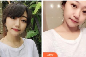 諸暨市中心醫(yī)院整形美容科何月勇整形價(jià)格表附切開雙眼皮案例展示