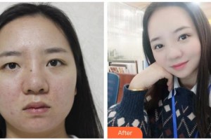 諸暨愛爾眼科醫(yī)院李志強(qiáng)整形價(jià)格表附切開雙眼皮案例展示