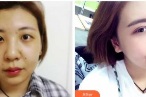 諸暨愛爾眼科醫(yī)院張玉整形價(jià)格表附激光去眼袋案例展示