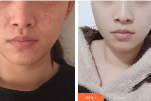 中南大學(xué)湘雅二醫(yī)院燒傷整形外科王先成整形價格表附激光祛斑案例展示