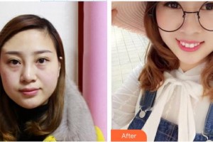 中南大學(xué)湘雅三醫(yī)院燒傷整形外科賀全勇整形價格表附清潔祛痘案例展示